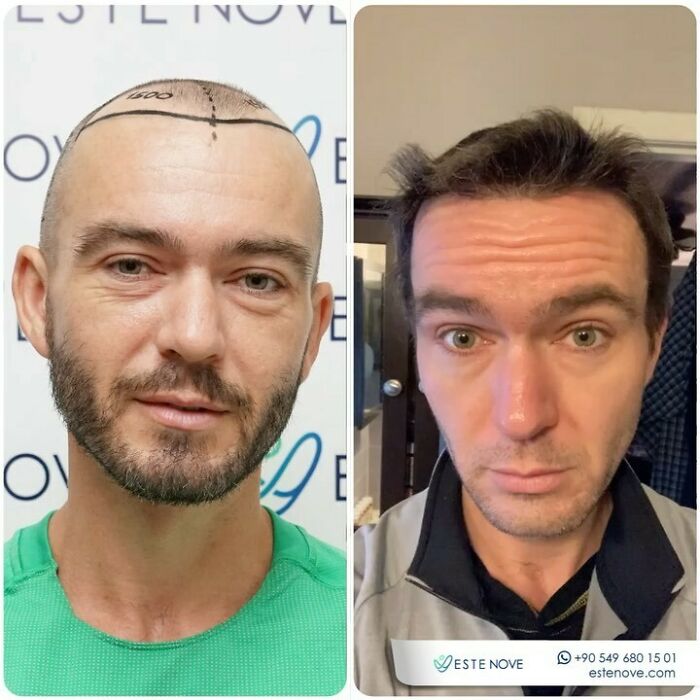 Before and after photos of a man showing hair transplant results with significant hair restoration and improved hairline.