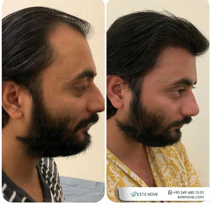 Side-by-side before and after photos showing hair transplant results on a man's hairline and scalp.