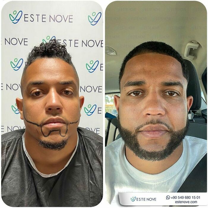 Before and after hair transplant photos of a man showing hairline design and full beard restoration results.