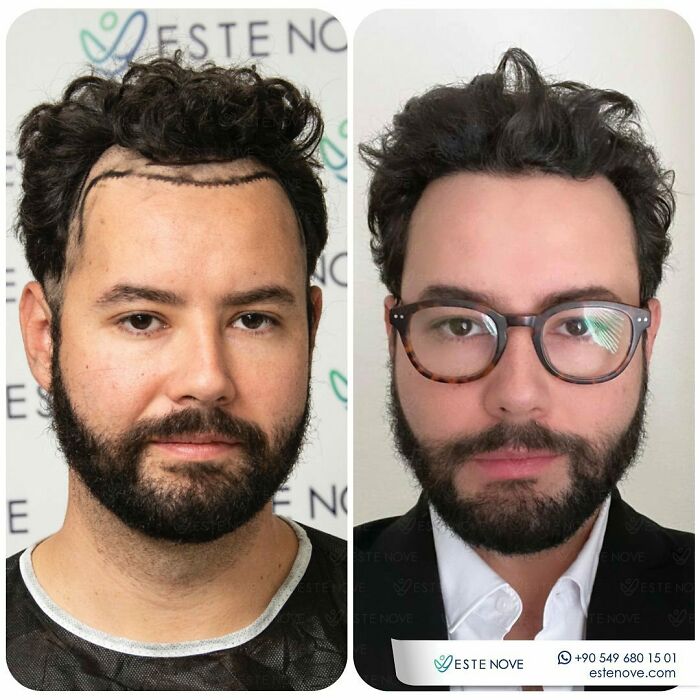 Man before and after hair transplant procedure showing improved hairline and thicker hair in side-by-side comparison photos.