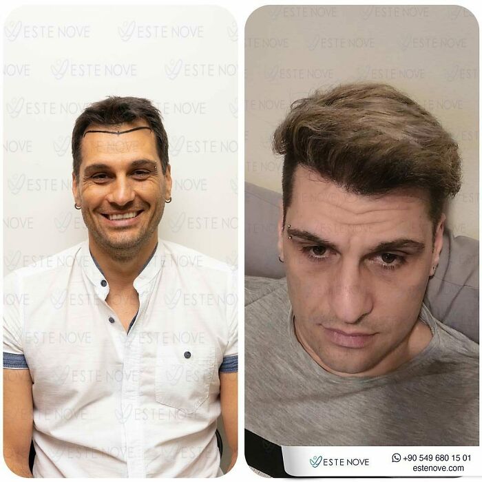 Before and after hair transplant photos showing visible hair restoration results on two men by surgeons.