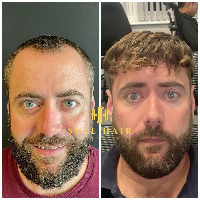 Before and after hair transplant photos showing restored hairline and increased hair density on two men’s heads.