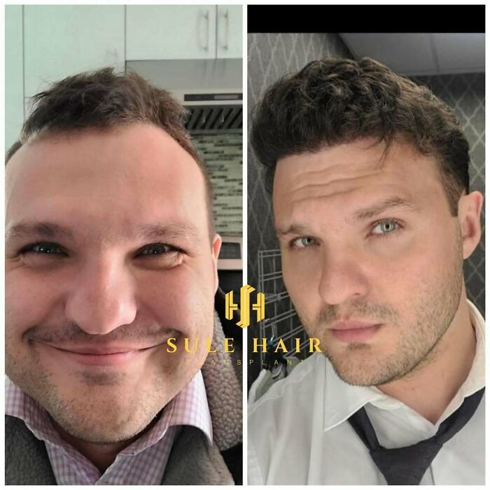 Before and after hair transplant photos showing improved hair density and natural hairline restoration results.