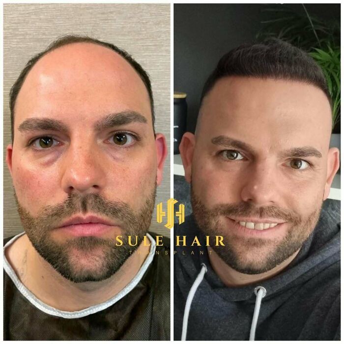 Before and after hair transplant results showing restored hairline and increased hair density on a smiling man’s face.