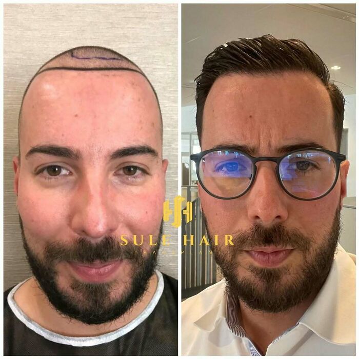 Before and after hair transplant photos showing hair restoration results on a man with a beard and glasses.