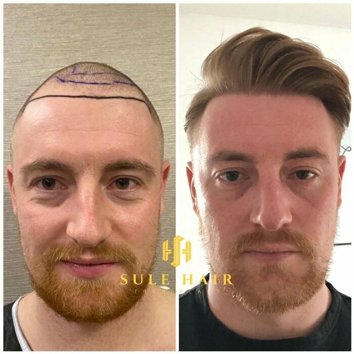 Before and after hair transplant results showing restored hairline and thicker hair on a man's scalp and forehead area.