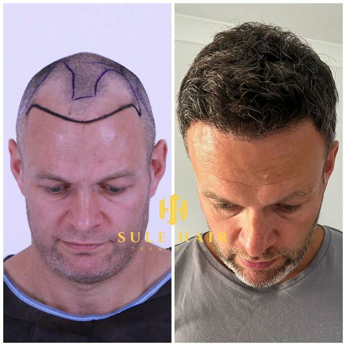 Before and after hair transplant photos of a man showing improved hair growth and restored hairline by surgeons.