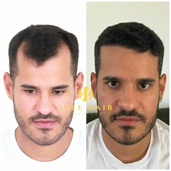 Before and after hair transplant results on a man showing improved hair density and hairline restoration.