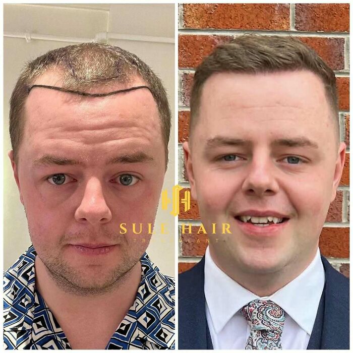 Before and after hair transplant photos of a man showing significant hair restoration and improved hairline.