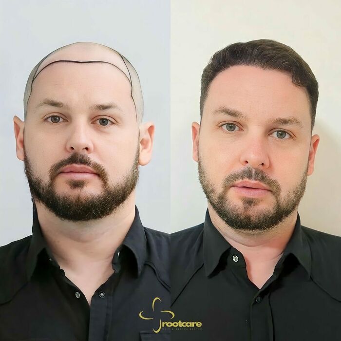 Before and after hair transplant images showing restored hairline and improved hair density on a man's scalp by surgeons.