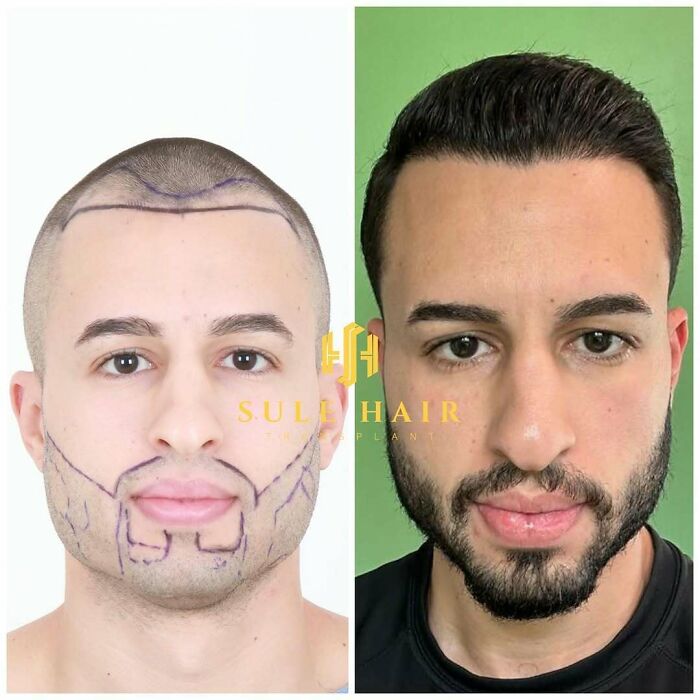 Before and after hair transplant photos showing a man with marked hairline and full natural hair growth post-procedure.