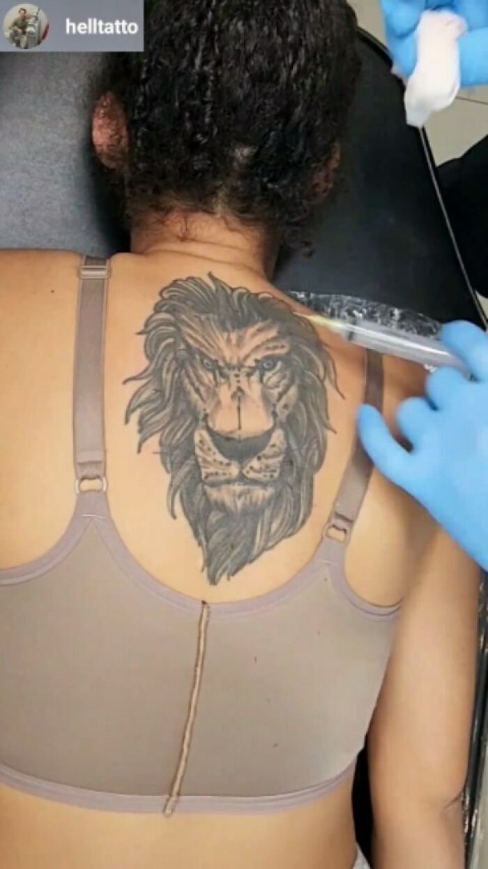 Person receiving ink removal injection on a large lion tattoo on their upper back, showing ink fail and regret.