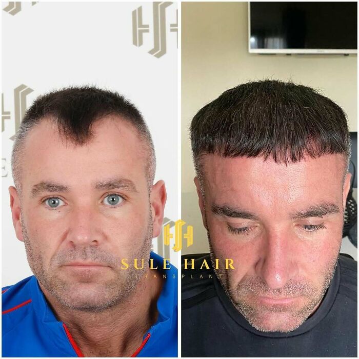 Before and after hair transplant photos showing improved hair density and restoration on a man's scalp by surgeons.