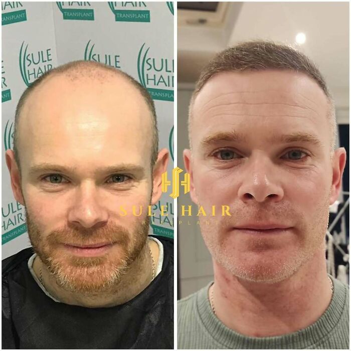 Before and after hair transplant results showing significant improvement in hair density and hairline restoration on a man's scalp.