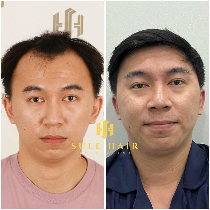 Before and after hair transplant results on a man showing improved hair density and natural hairline restoration.