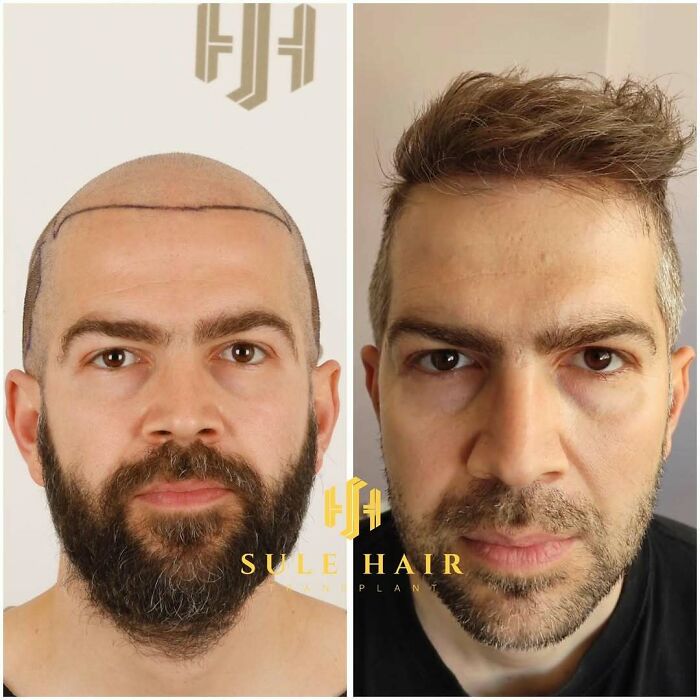 Before and after hair transplant results showing improved hairline and natural hair growth on a male patient’s scalp.