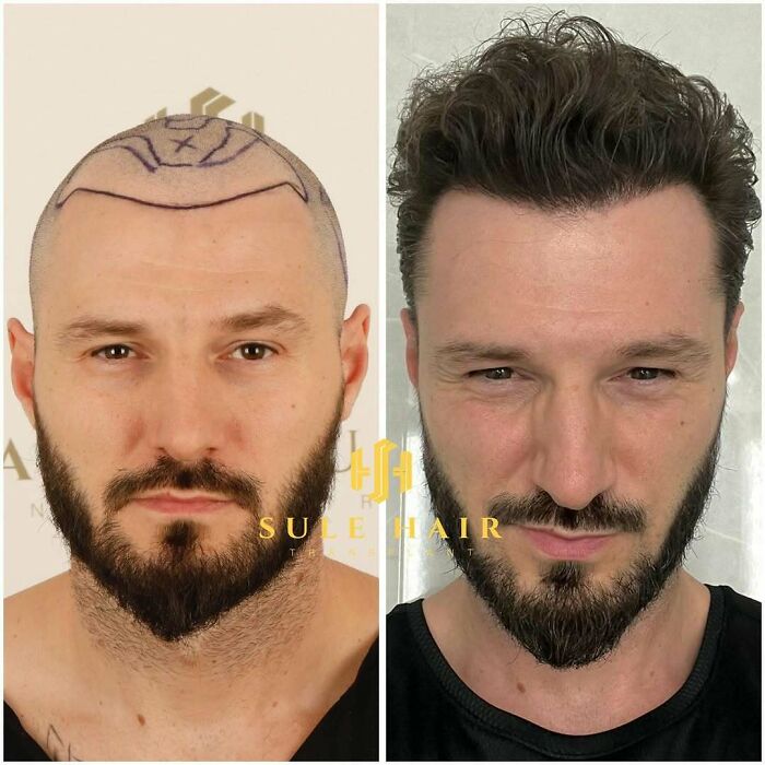 Before and after images of a man showing the results of a hair transplant with improved hair density and hairline.
