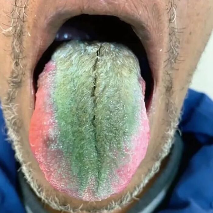 Close-up of a person’s tongue showing green hairy tongue condition with textured and discolored surface inside mouth.