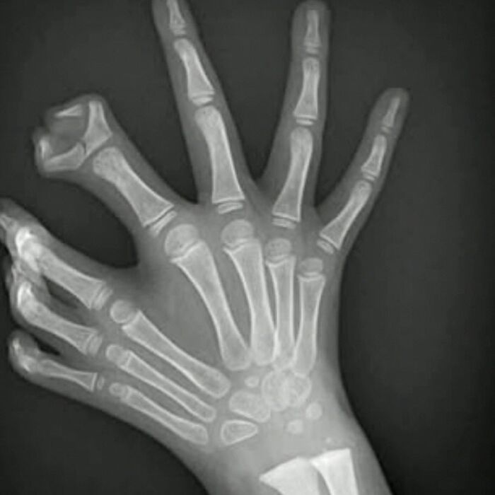 X-ray image showing a rare medical condition with an abnormal number of fingers on a hand for medical caution.