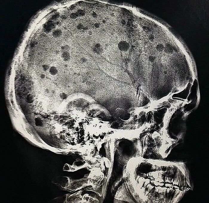 X-ray image of a human skull showing irregular dark spots, related to medical imaging of green hairy tongue conditions.