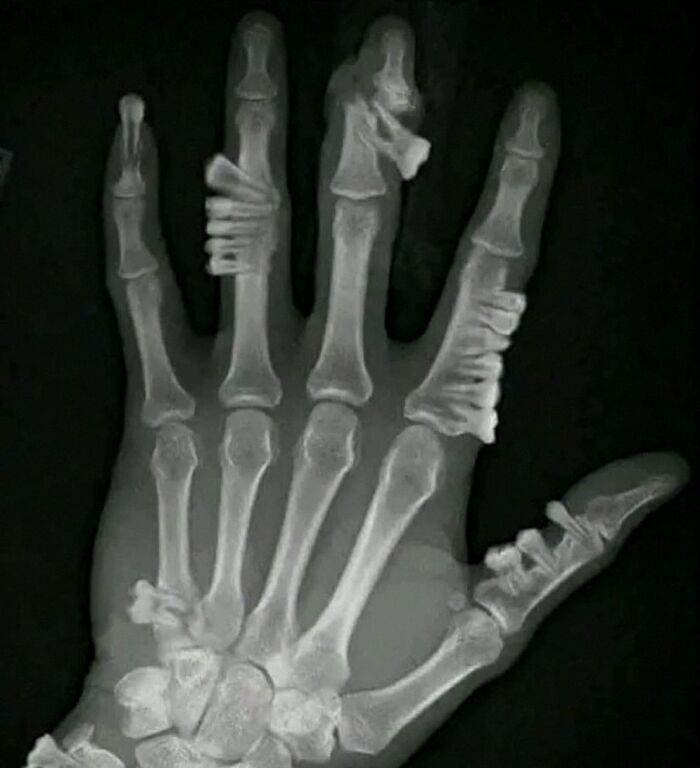 X-ray image of a hand showing unusual bone deformities and abnormalities in a medical context.