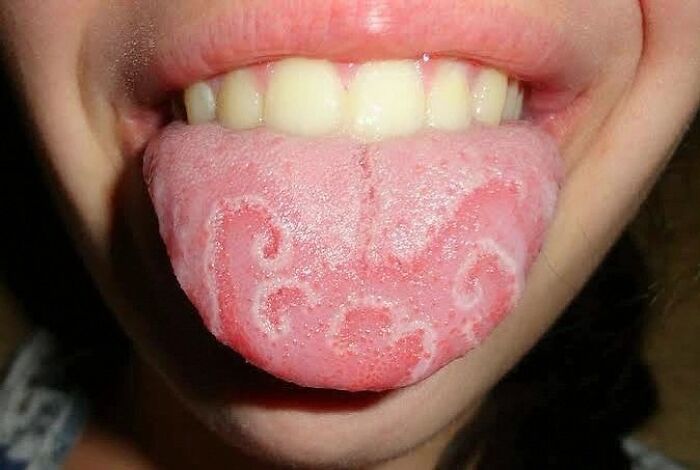 Close-up of a tongue showing a green hairy tongue condition with visible texture and discoloration on the surface.
