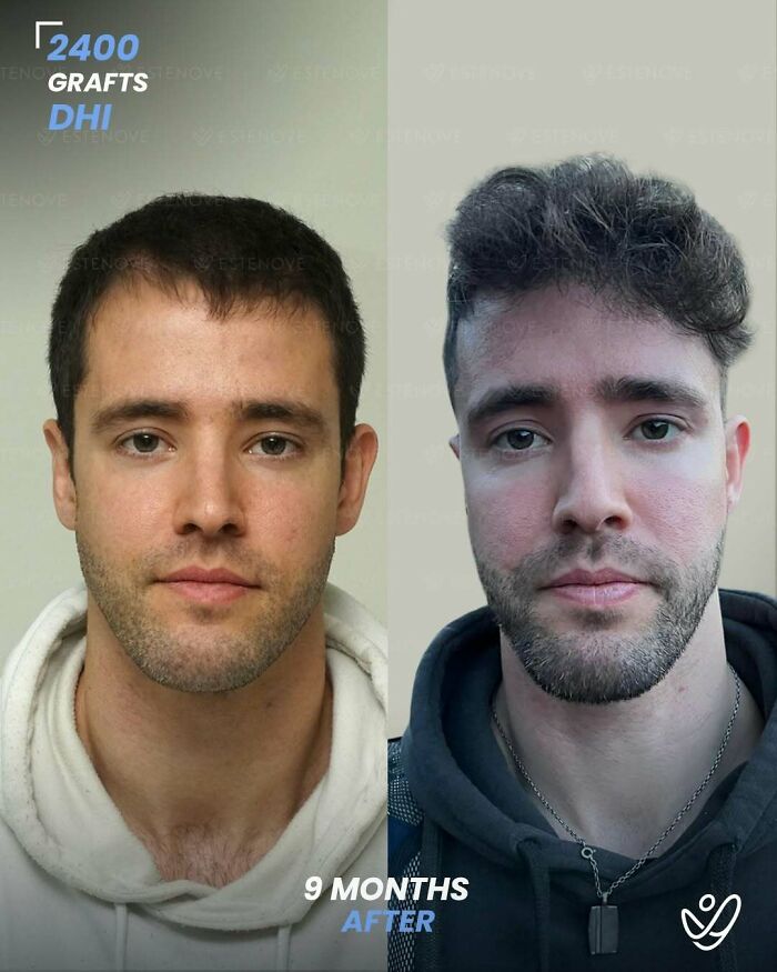 Before and after hair transplant photos showing results with 2400 grafts DHI method after 9 months.