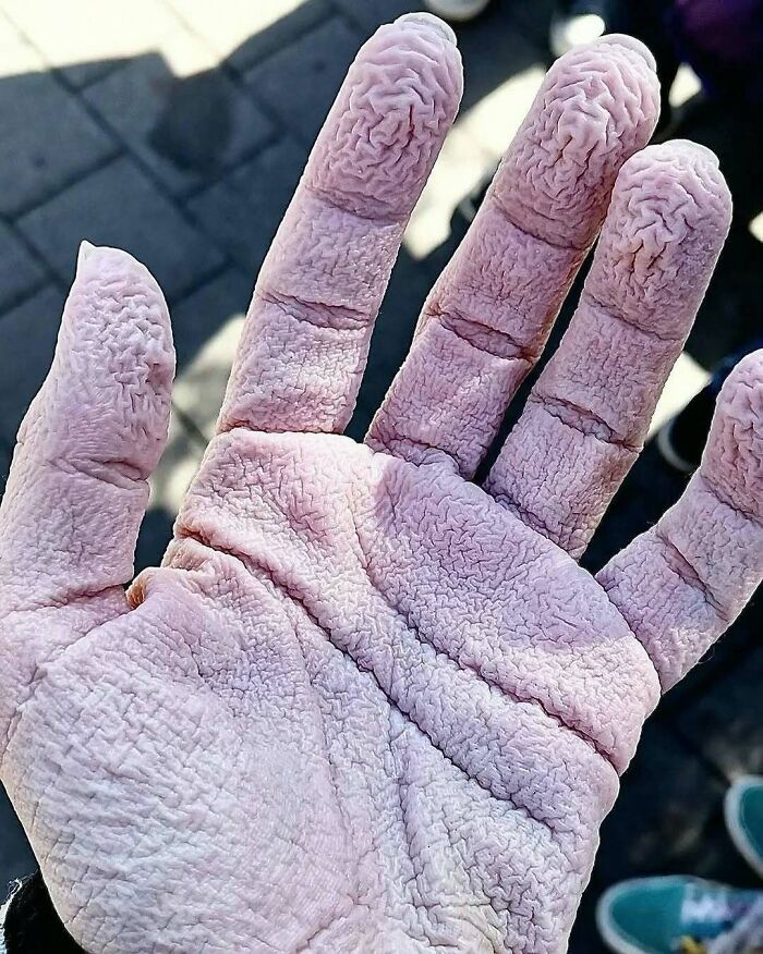 Close-up of a wrinkled human hand with extreme skin texture, illustrating medical condition caution related to green hairy tongue.