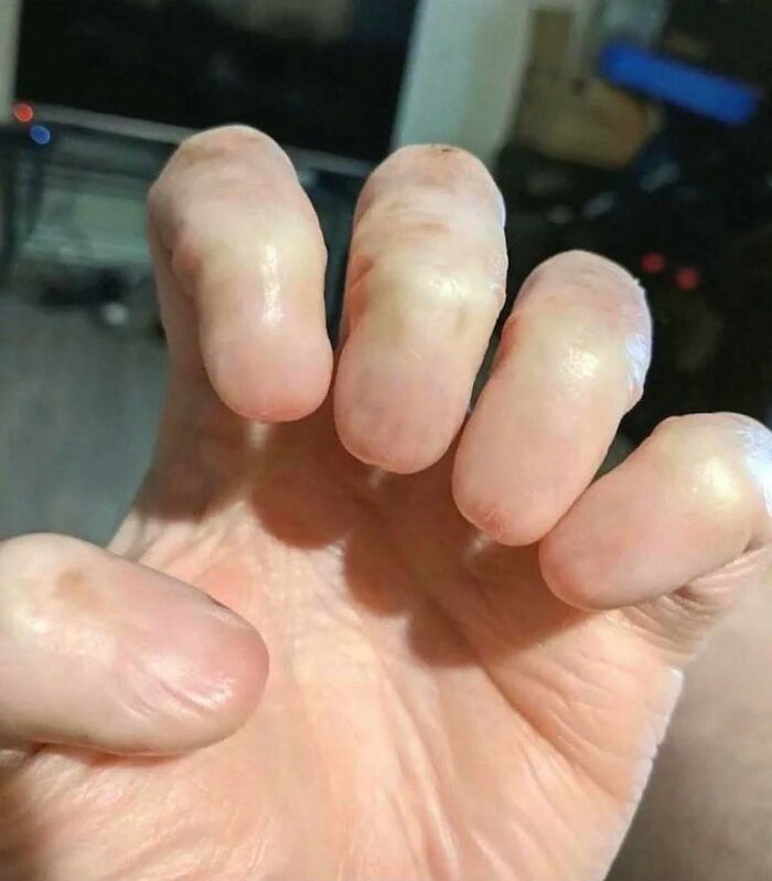 Close-up of swollen, smooth fingertips showing unusual skin texture, highlighting a rare medical condition symptom.
