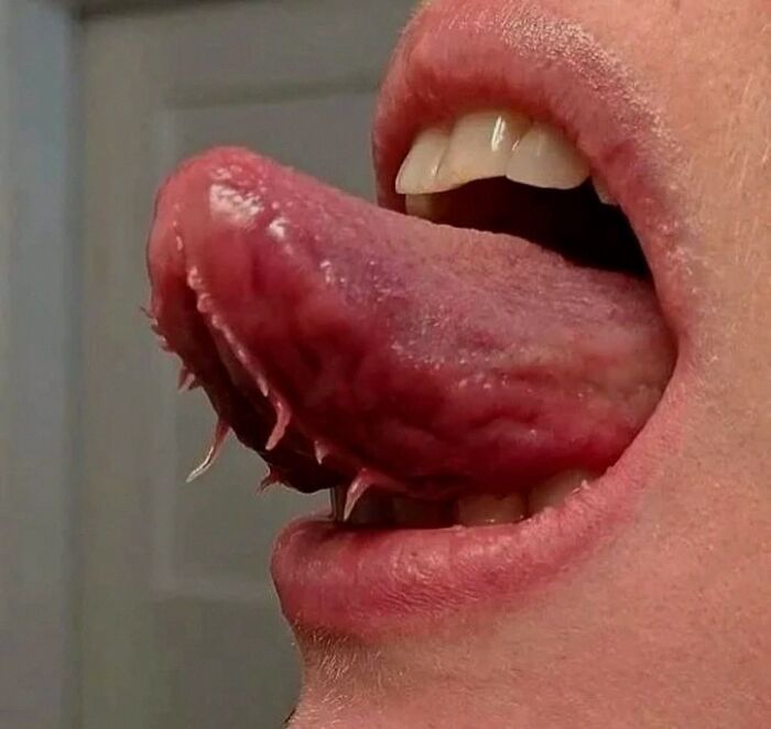 Close-up of a hairy tongue with abnormal growths, showing a rare medical condition affecting the tongue surface.