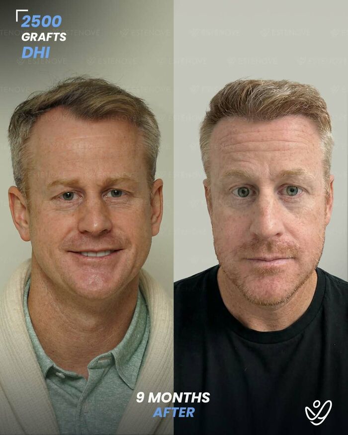 Before and after hair transplant photos showing 2500 grafts with DHI technique and results 9 months later.