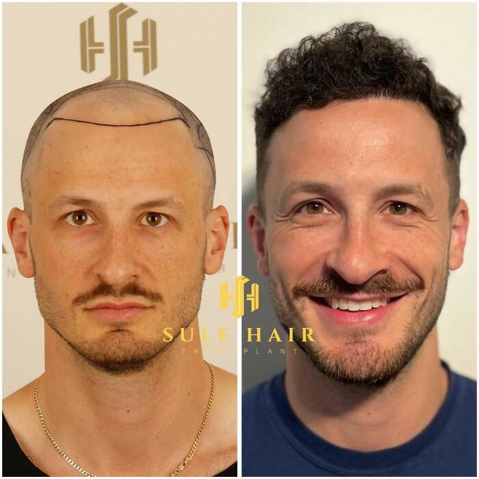 Before and after hair transplant photos showing significant hair restoration and improved appearance of a male patient.