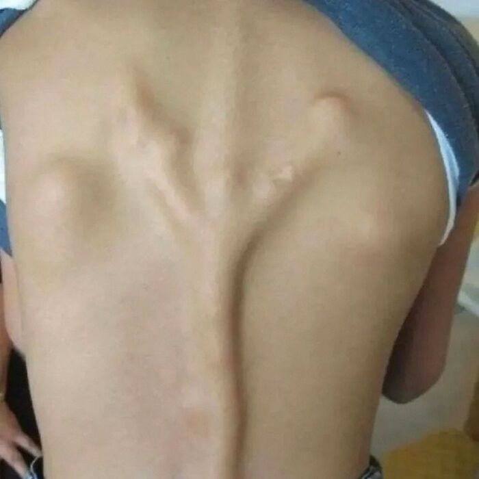 Image showing a severe spinal deformity with pronounced ridges, related to medical conditions caution.