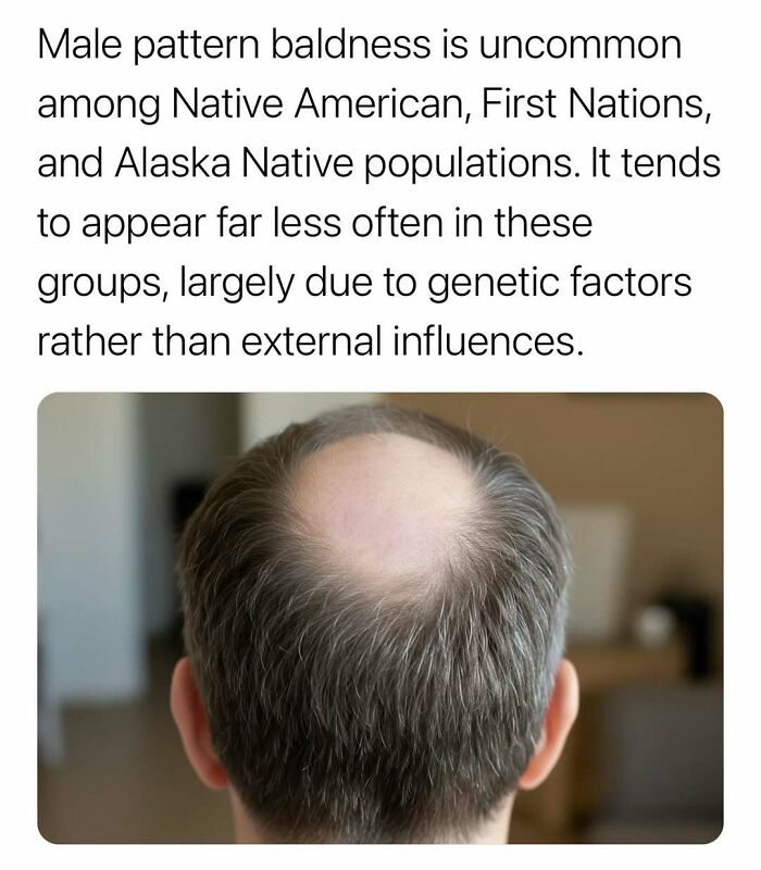 Male pattern baldness less common in Native American groups due to genetic factors, shown with a balding man’s head from behind.