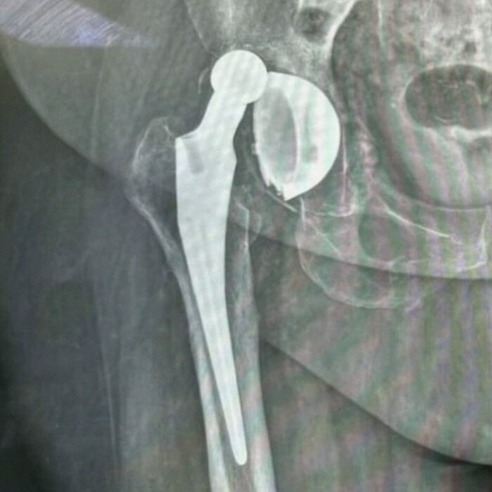 X-ray image showing a hip joint replacement with a fractured green hairy tongue medical implant.