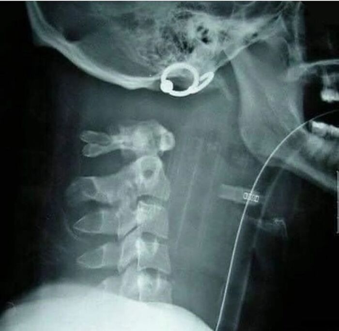 X-ray showing cervical spine and neck with medical devices, related to green hairy tongue medical images.