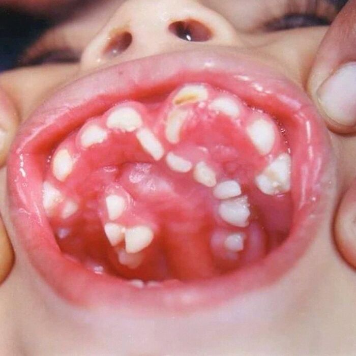 Close-up of a mouth showing unusual dental and oral condition relevant to medical images of hairy tongue.