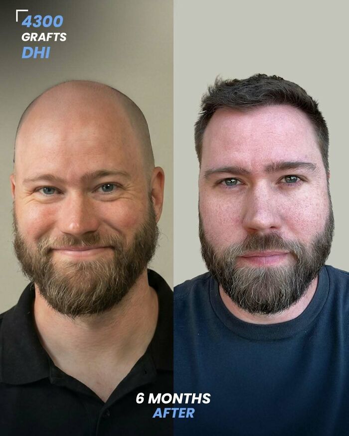Before and after hair transplant photos showing 4300 grafts using DHI method with results after 6 months on a smiling man.