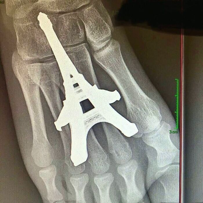 X-ray image of foot bones showing a metal implant shaped like the Eiffel Tower, illustrating a unique medical case.
