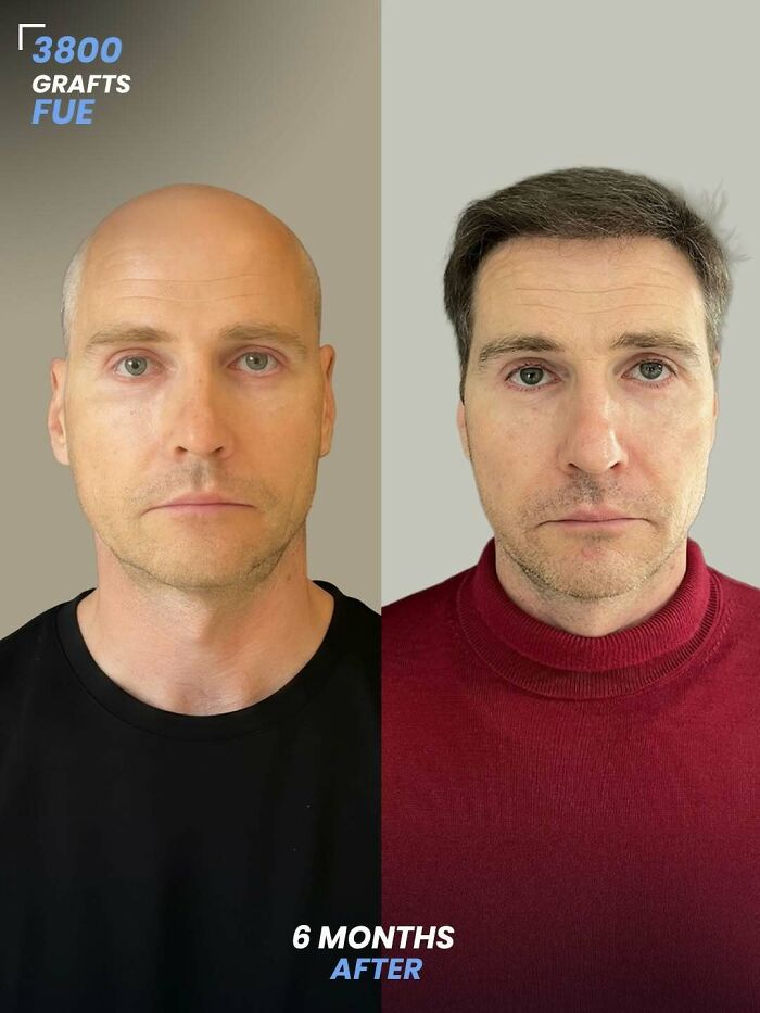 Before and after hair transplant photo showing results six months after 3800 grafts FUE procedure on a male patient.