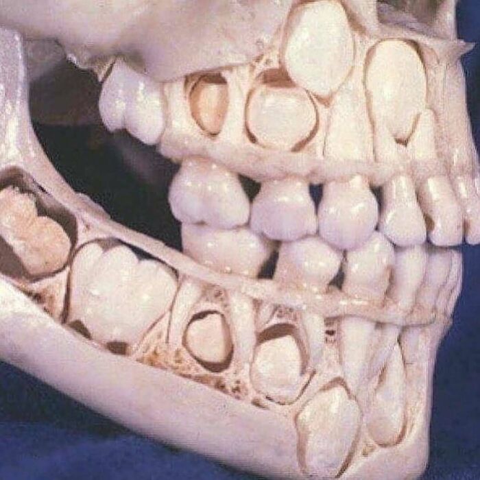 Cross-section of human jaw showing developing teeth and dental anatomy in a medical illustration related to green hairy tongue.