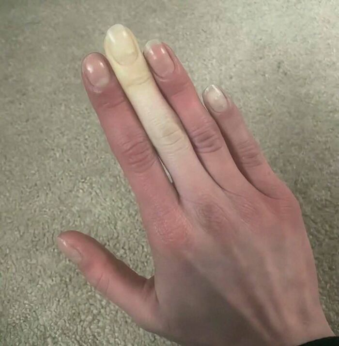 Hand with one finger showing a green hairy tongue condition surrounded by normal skin and nails on a neutral background.