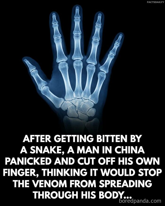 X-ray of a hand with text about a man cutting off his finger after a snake bite, featuring surprising facts.