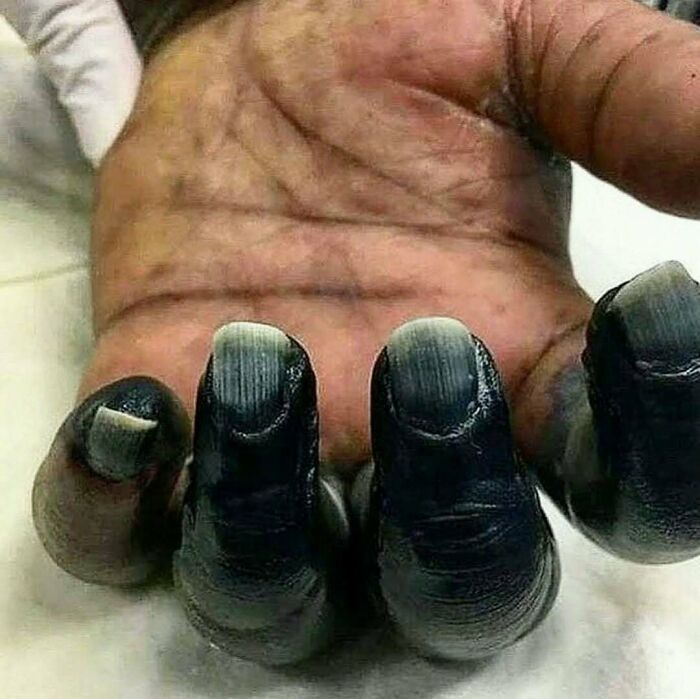 Severe black discoloration and damage to fingernails and fingers, resembling a medical condition or injury.