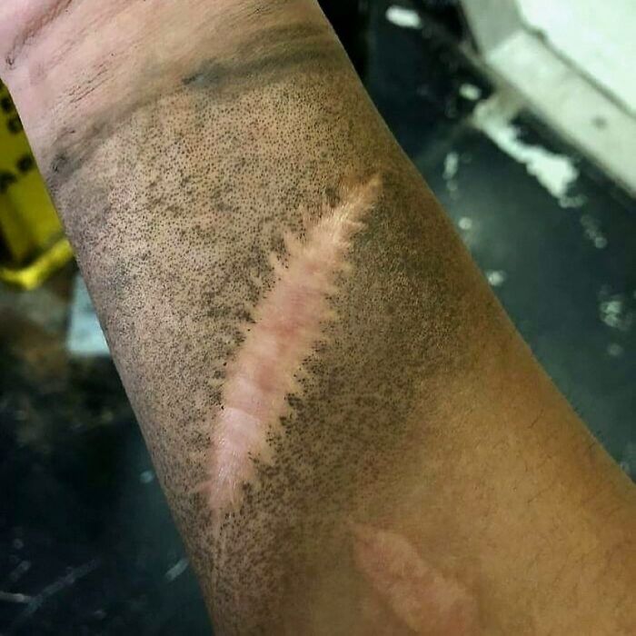 Close-up of a skin scar with surrounding hair follicles highlighting a medical condition related to green hairy tongue.