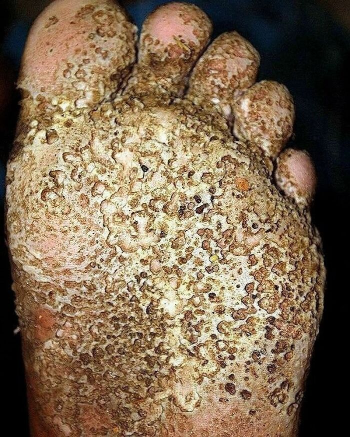 Close-up of a foot with severe skin condition showing rough, scaly, and cracked texture warning of medical concern.