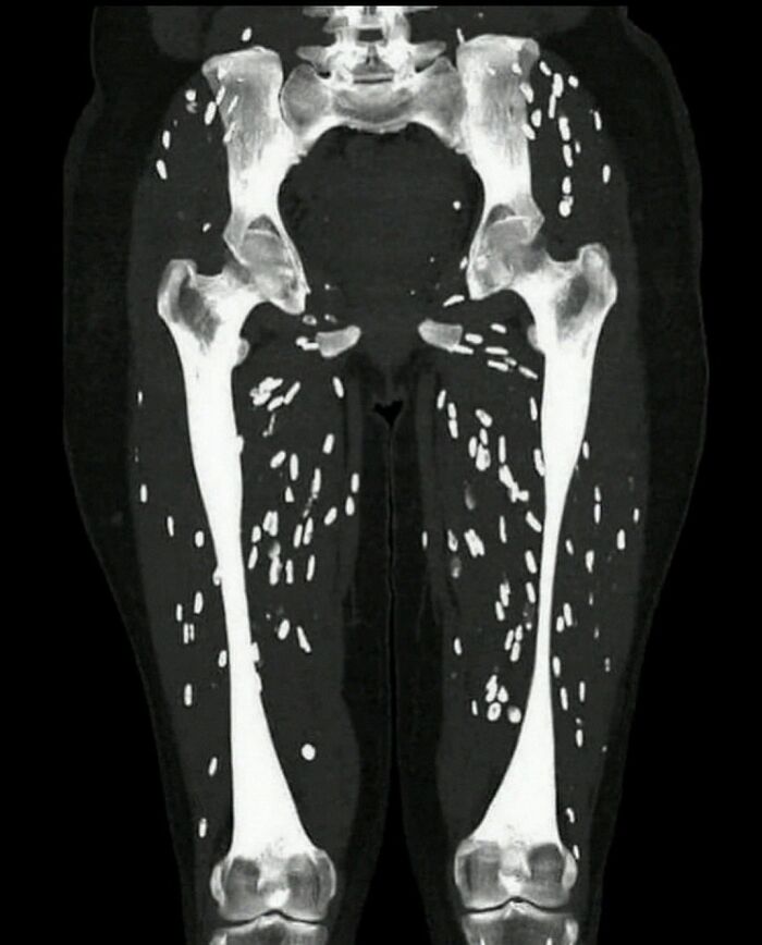 CT scan showing multiple small bright spots scattered throughout thigh muscles, related to medical images involving green hairy tongue.