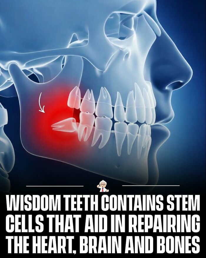 X-ray view of wisdom teeth with inflammation highlighting interesting facts and stories from all over the world.