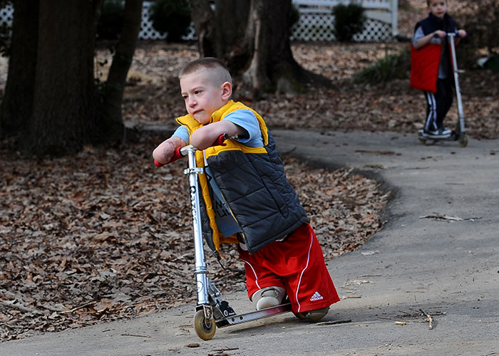 Young boy with no arms or legs riding a scooter on a paved path surrounded by trees and fallen leaves.