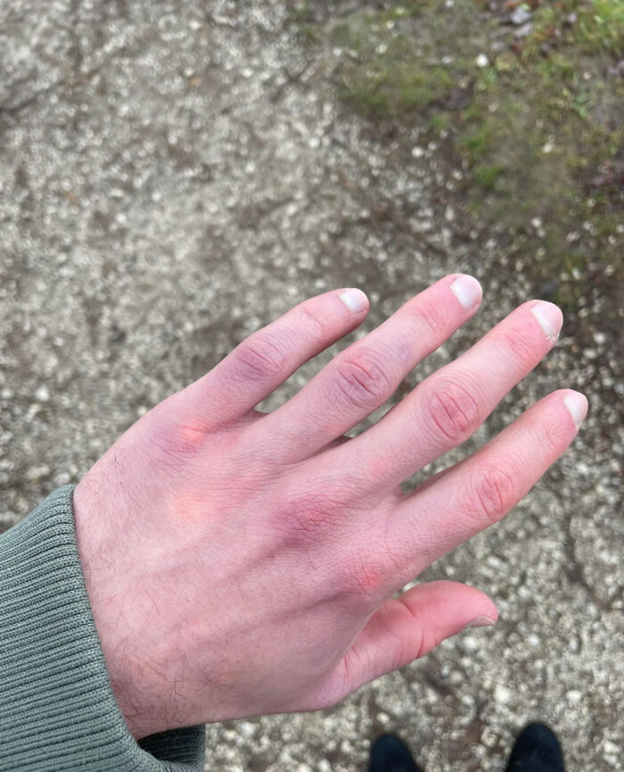 Hand with discolored and purple fingers showing signs of malfunctioning brain or circulation issues during a dumb ER visit.